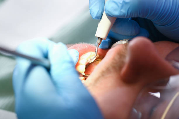 Best Emergency Wisdom Teeth Removal in Greenville, OH
